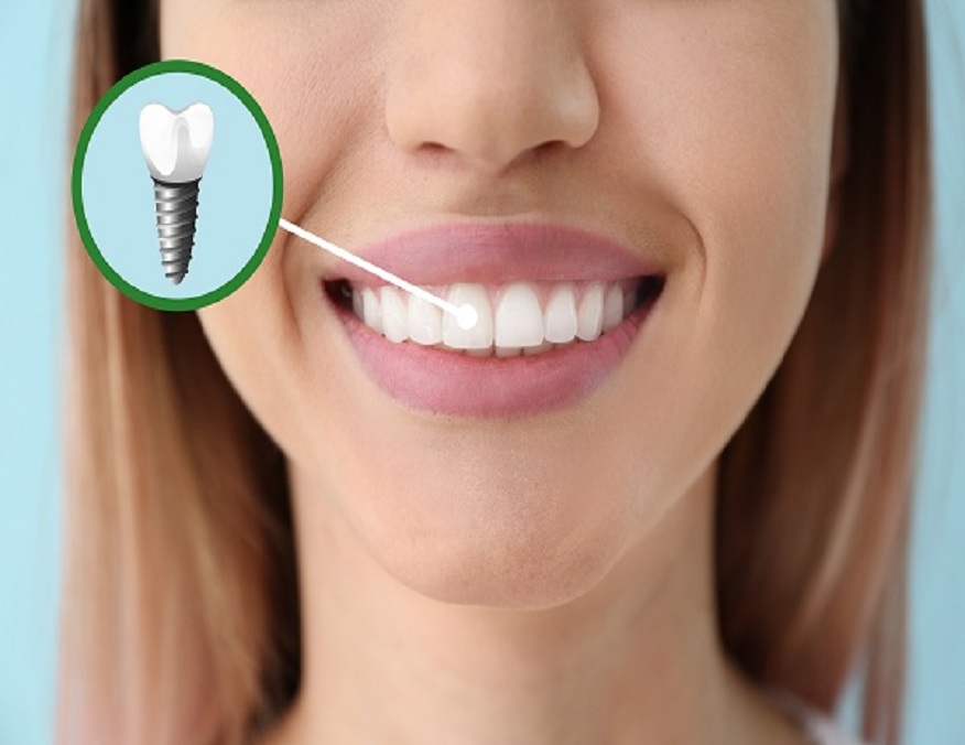 dental implant: